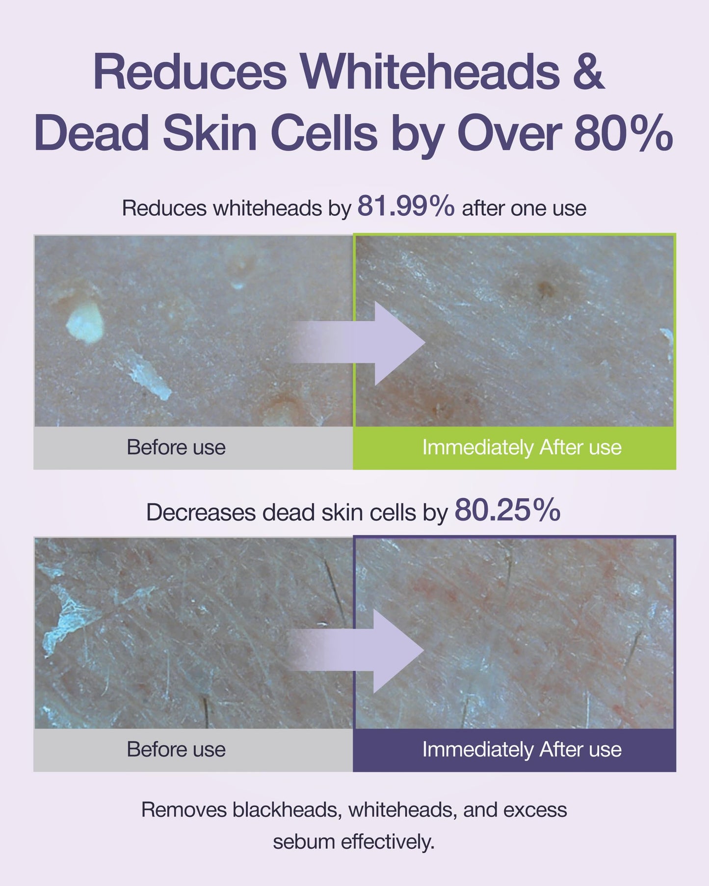 CENTELLIAN 24 Madeca Real Green Pore Nose Patch (0.24fl oz, Pack of 5) - Dual-Step Bio-Cellulose Sheet, Reduces Whiteheads & Blackheads, Soothes & Tightens Pores, Korean Skin Care. TECA, Liposome