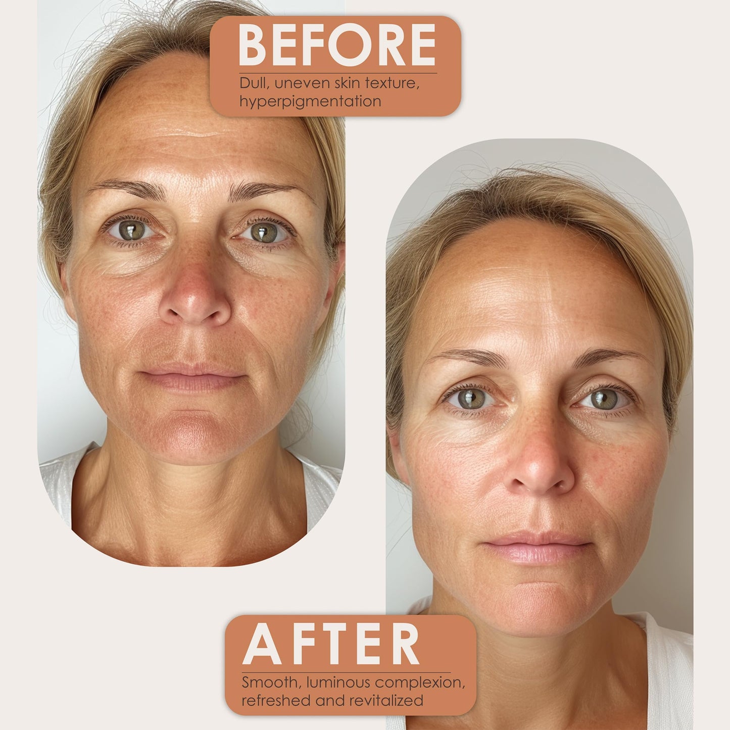 SimpleField Turmeric and Kojic Acid Soap Bar for Reduce Dark Spots & Even Skin Tone – With Vitamin C, Glycerin & Tea Tree Oil – Gentle Cleanse & Hydration for Face & Body (2 Pack)