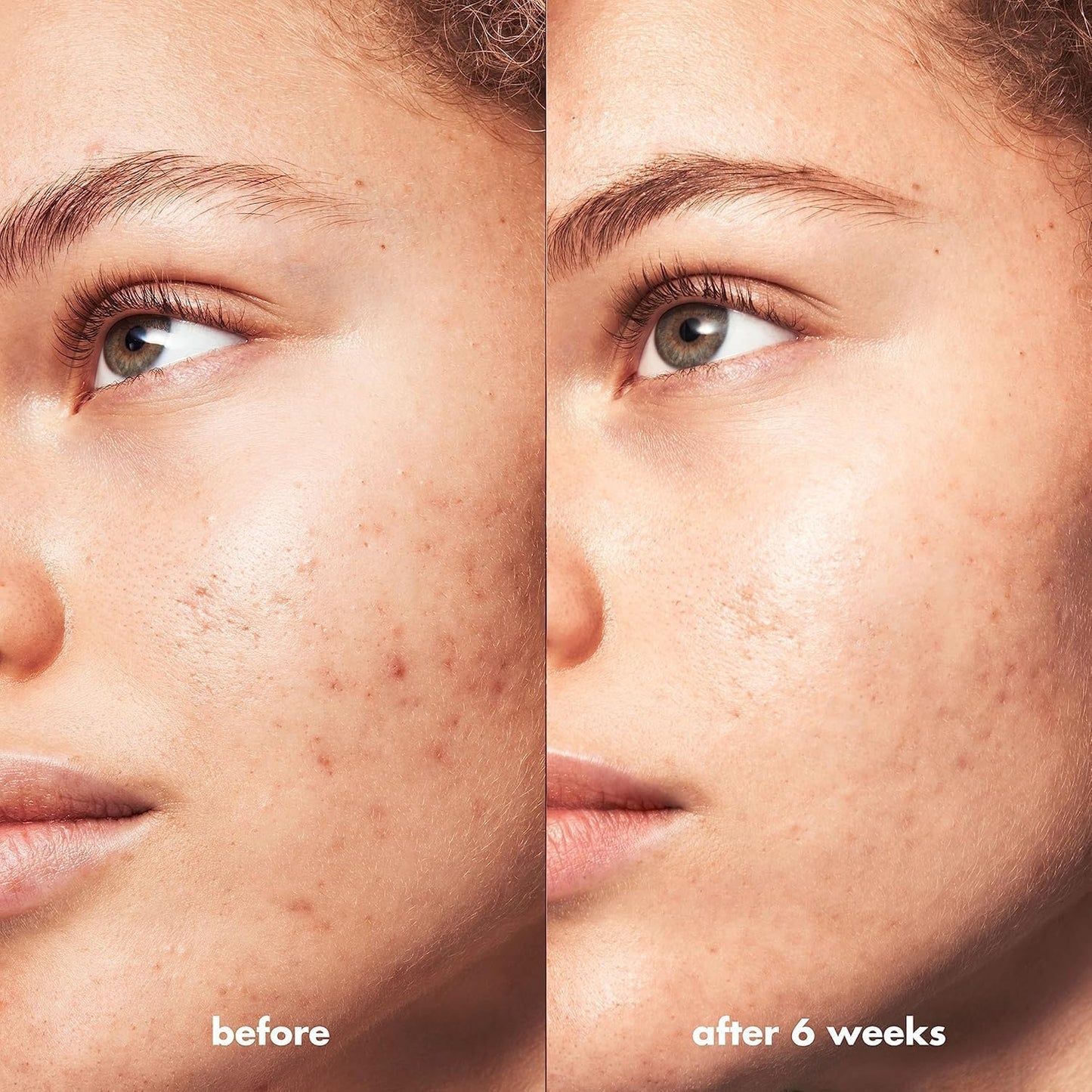 e.l.f. SKIN Blemish Breakthrough Triple-Acid Resurfacing Serum Mini, Hydrating Night Serum For Fighting Blemishes, Helps Improve Skin Tone & Texture