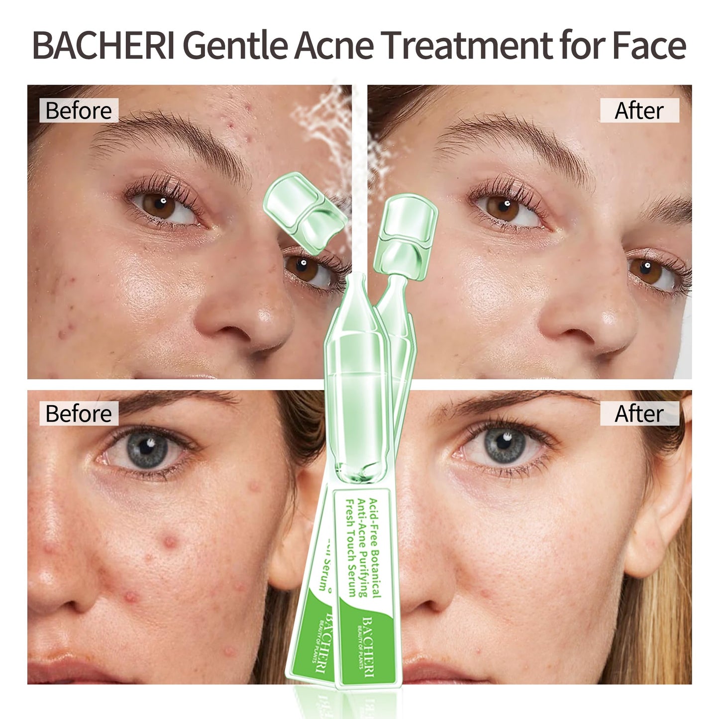 Gentle Botanical Acne Treatment for Face – Acid-Free Spot Facial Serum with Niacinamide & Witch Hazel, Soothes Redness & Controls Breakouts for Sensitive, Oily & Acne-Prone Skin – 1.2 ml × 30 Ampoules