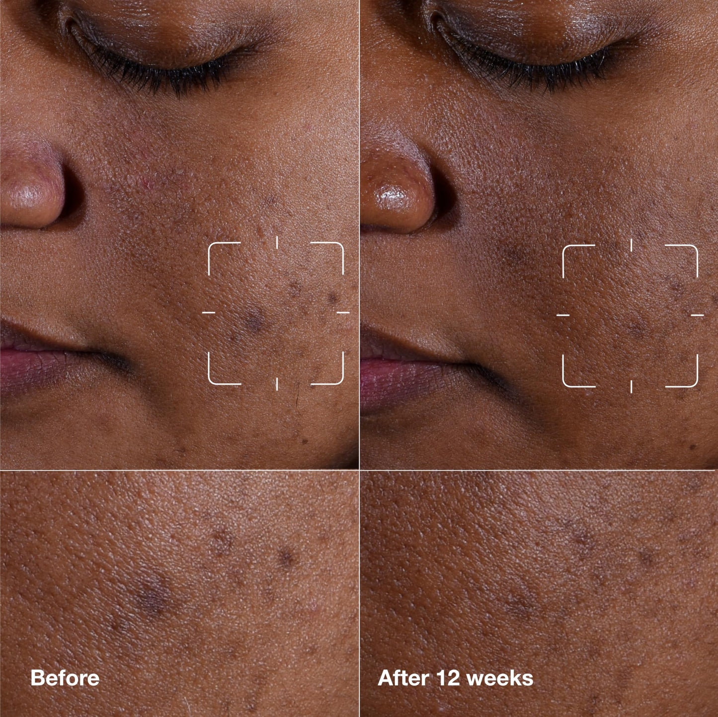 Clinique Even Better Clinical Dark Spot Clearing Vitamin C Face Serum For All Skin Types | Brightening + Soothing, 1 Fl Oz